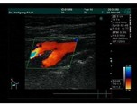 Ultraschall der Halsschlagader (Carotisduplex)