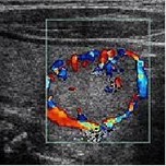 Thyroid ultrasound